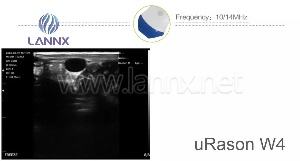 LANNX uRason W5 single head scanner-linear array Wireless ultrasound probe