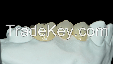 Dental Treatment Dental Metal Ceramic Crown Made  Dental Lab in