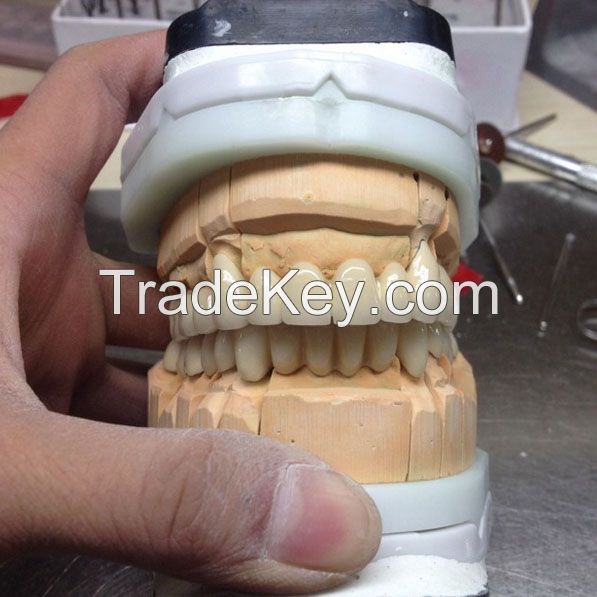 Emax Crowns - China Dental Lab Dental Crowns in Good Quality and Good Esthetics
