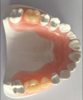 Dental Treatment Dental Metal Ceramic Crown Made  Dental Lab In