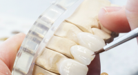 Emax Crowns - China Dental Lab Dental Crowns in Good Quality and Good Esthetics