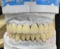 Porcelain-fused-to-metal (pfm) Crowns - China Dental Lab